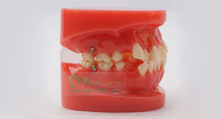 TM-B1 Orthodontic Model